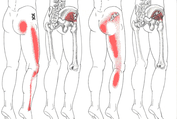 脊柱管狭窄症と診断を受けた痛み 原因は筋肉である ことがほとんどです 369 ラムサ福岡
